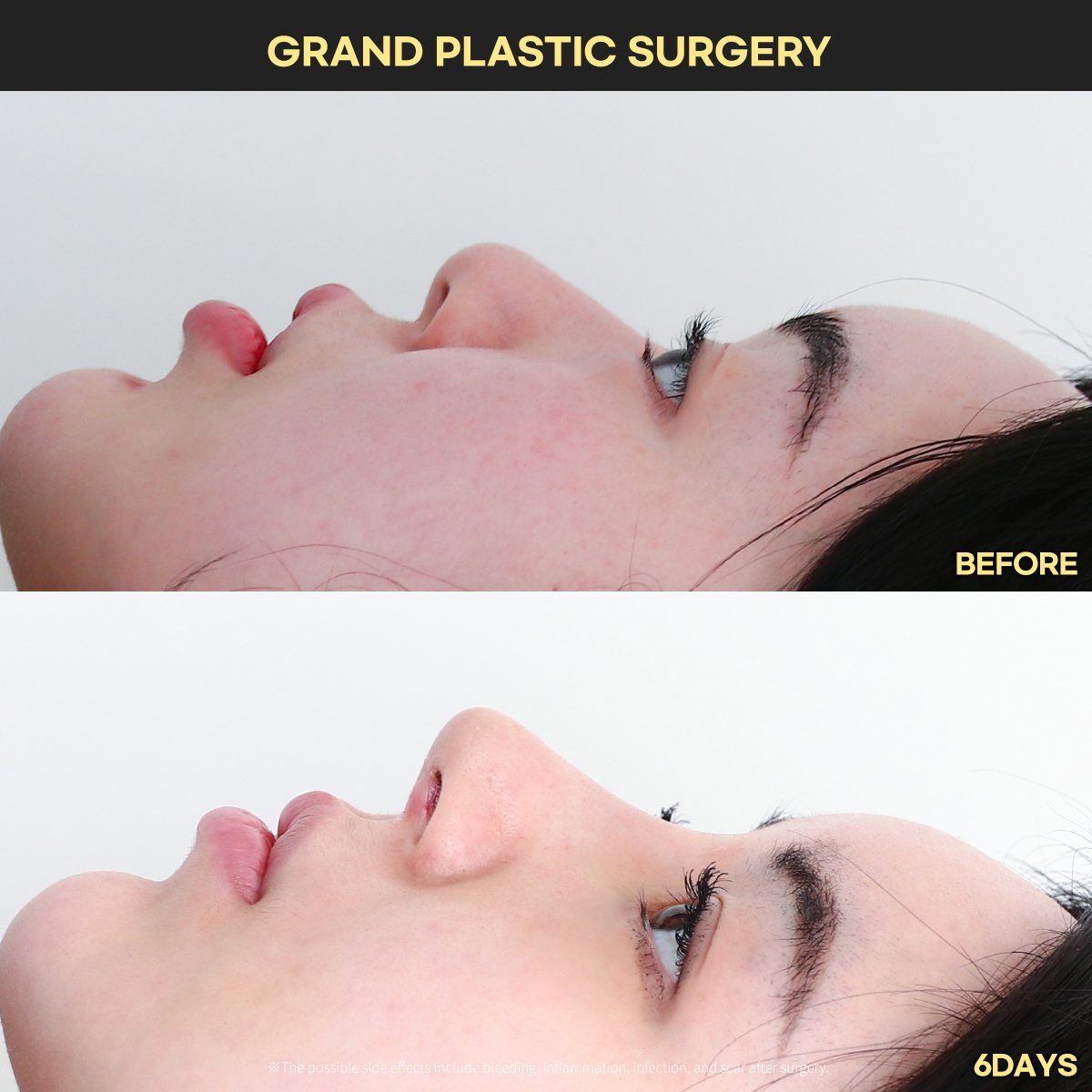 Rhinoplasty, profile: before and 6 days at Grand Plastic Surgery, Seoul