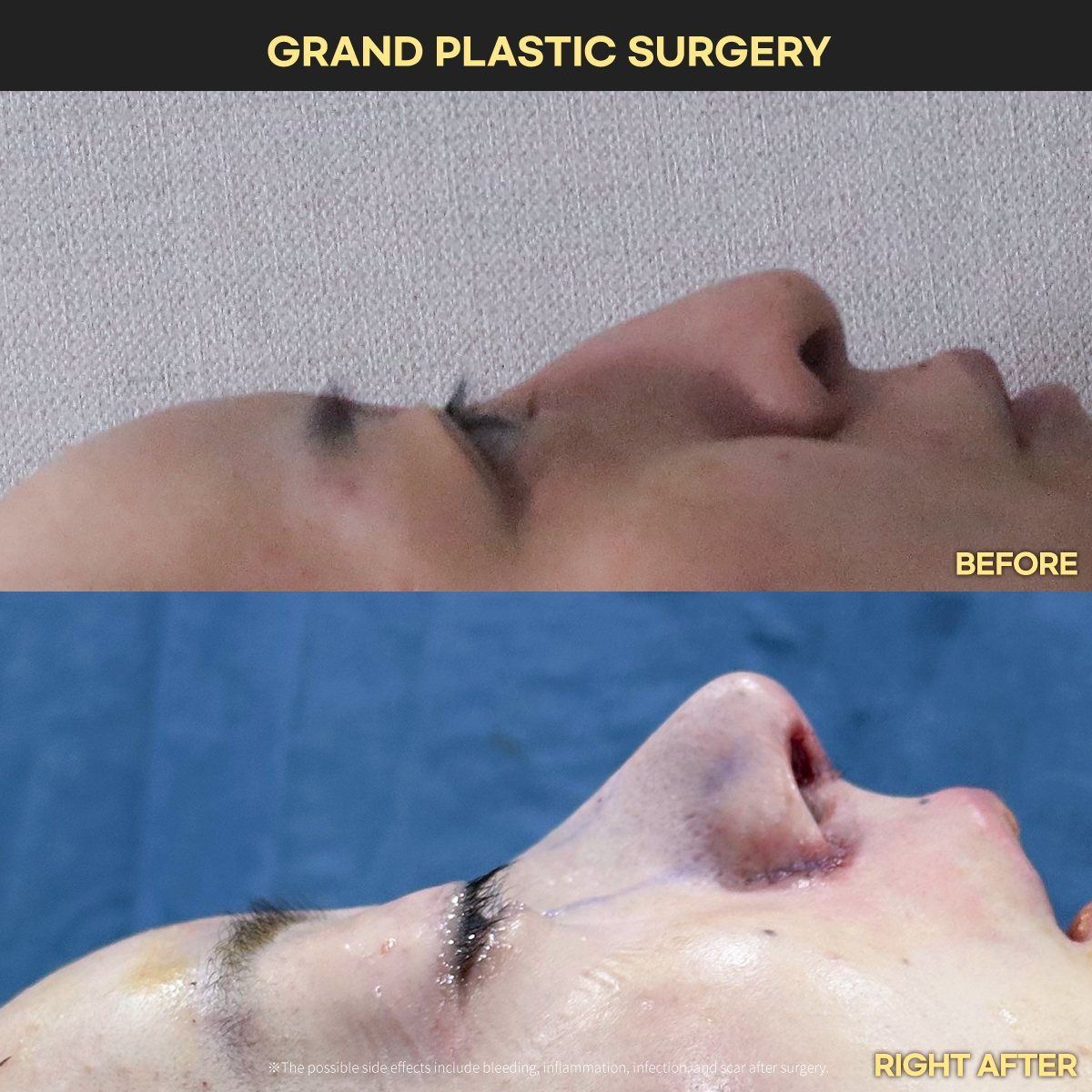 Rhinoplasty, profile: before and right after surgery at Grand Plastic Surgery, Seoul