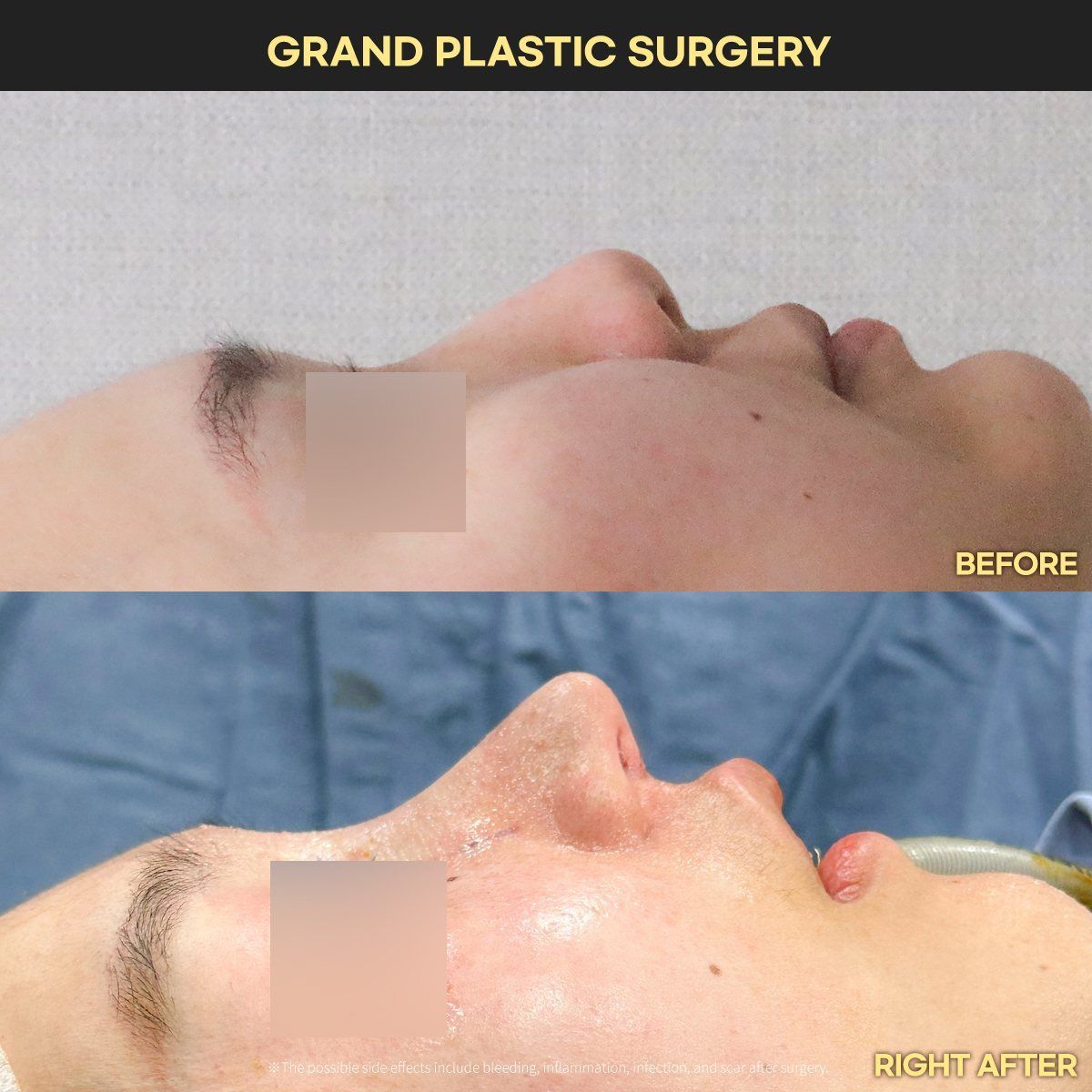 Rhinoplasty, profile: before and right after surgery at Grand Plastic Surgery, Seoul
