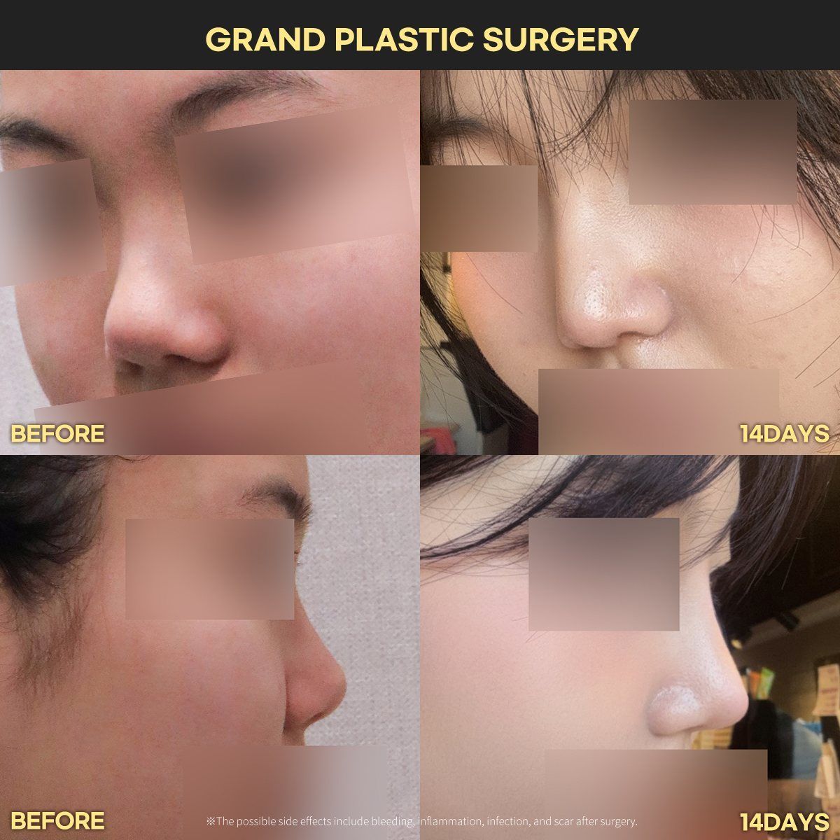 Rhinoplasty: before and 14 days at Grand Plastic Surgery, Seoul