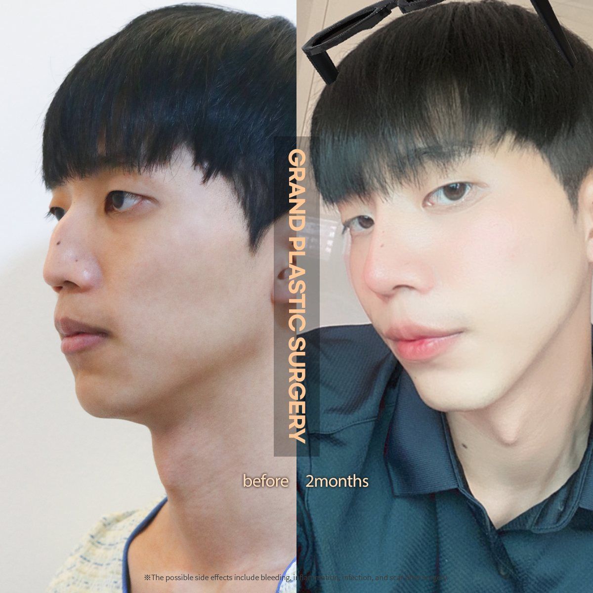 Male rhinoplasty: before and 2 months at Grand Plastic Surgery, Seoul