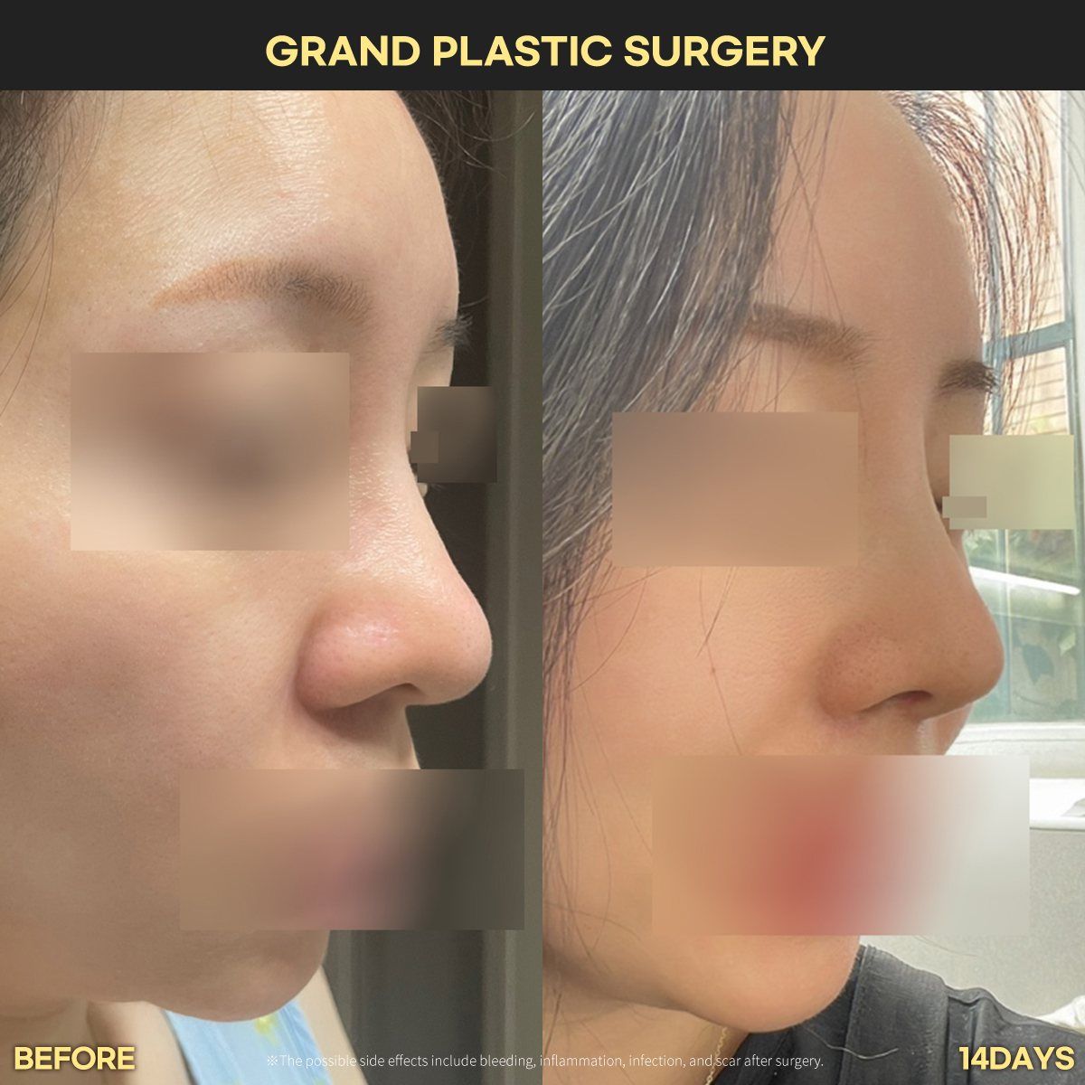 Rhinoplasty, profile: before and 14 days at Grand Plastic Surgery, Seoul