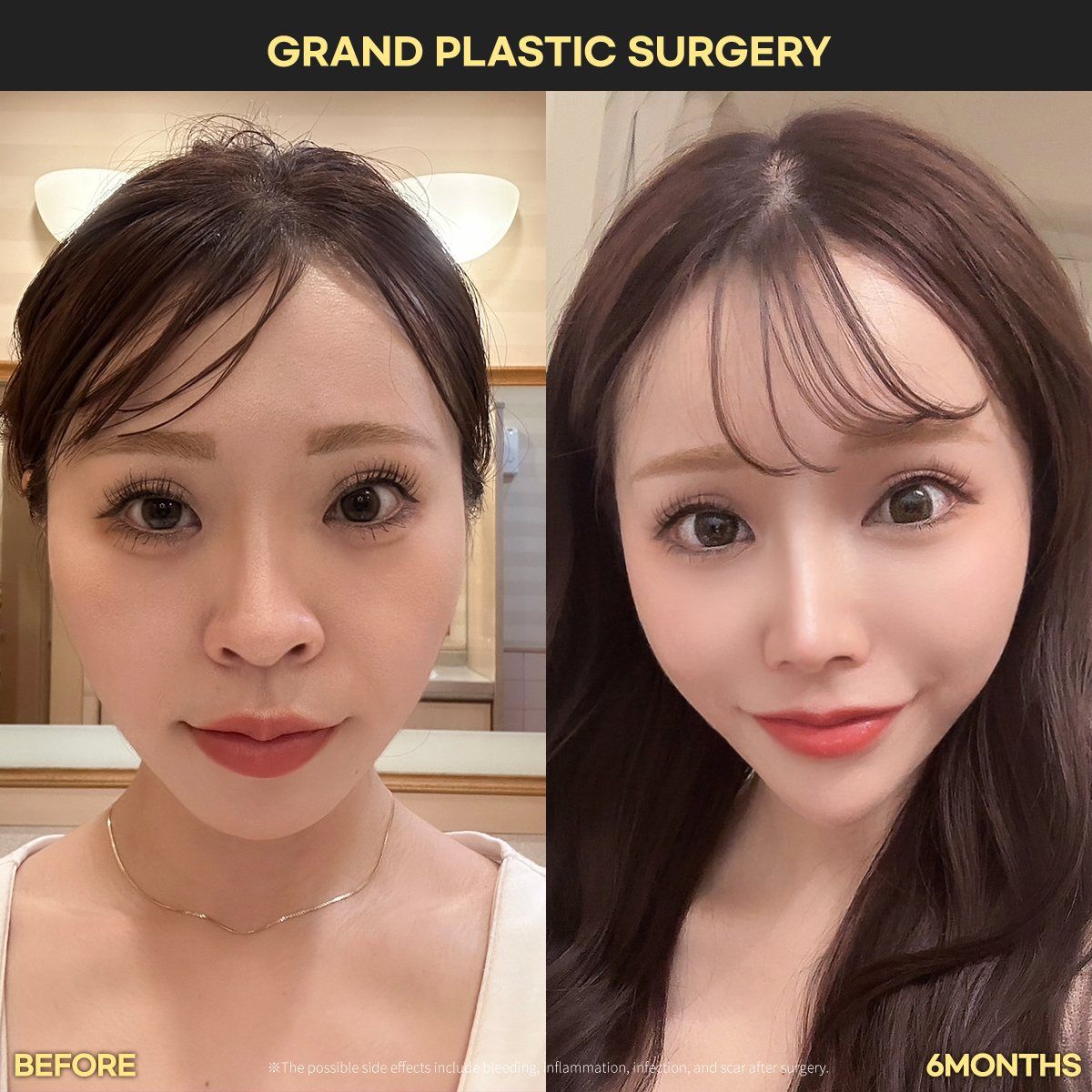 Rhinoplasty: before and 6 months at Grand Plastic Surgery, Seoul
