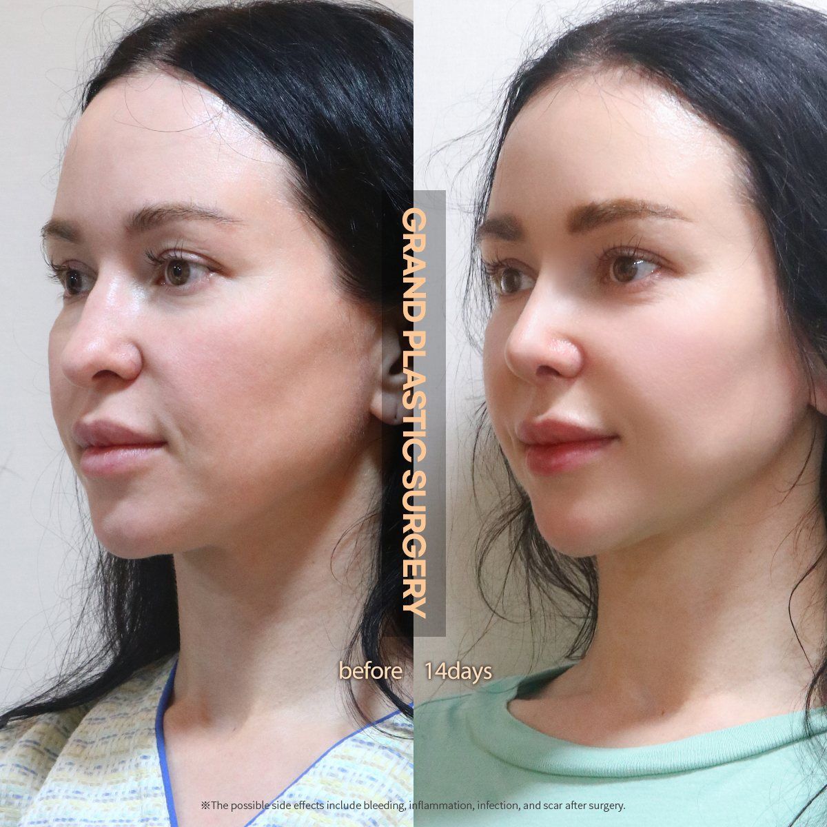 Rhinoplasty, oblique view: before and 14 days at Grand Plastic Surgery, Seoul