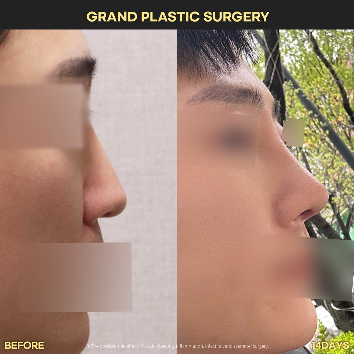 Male rhinoplasty, profile: before and 14 days at Grand Plastic Surgery, Seoul
