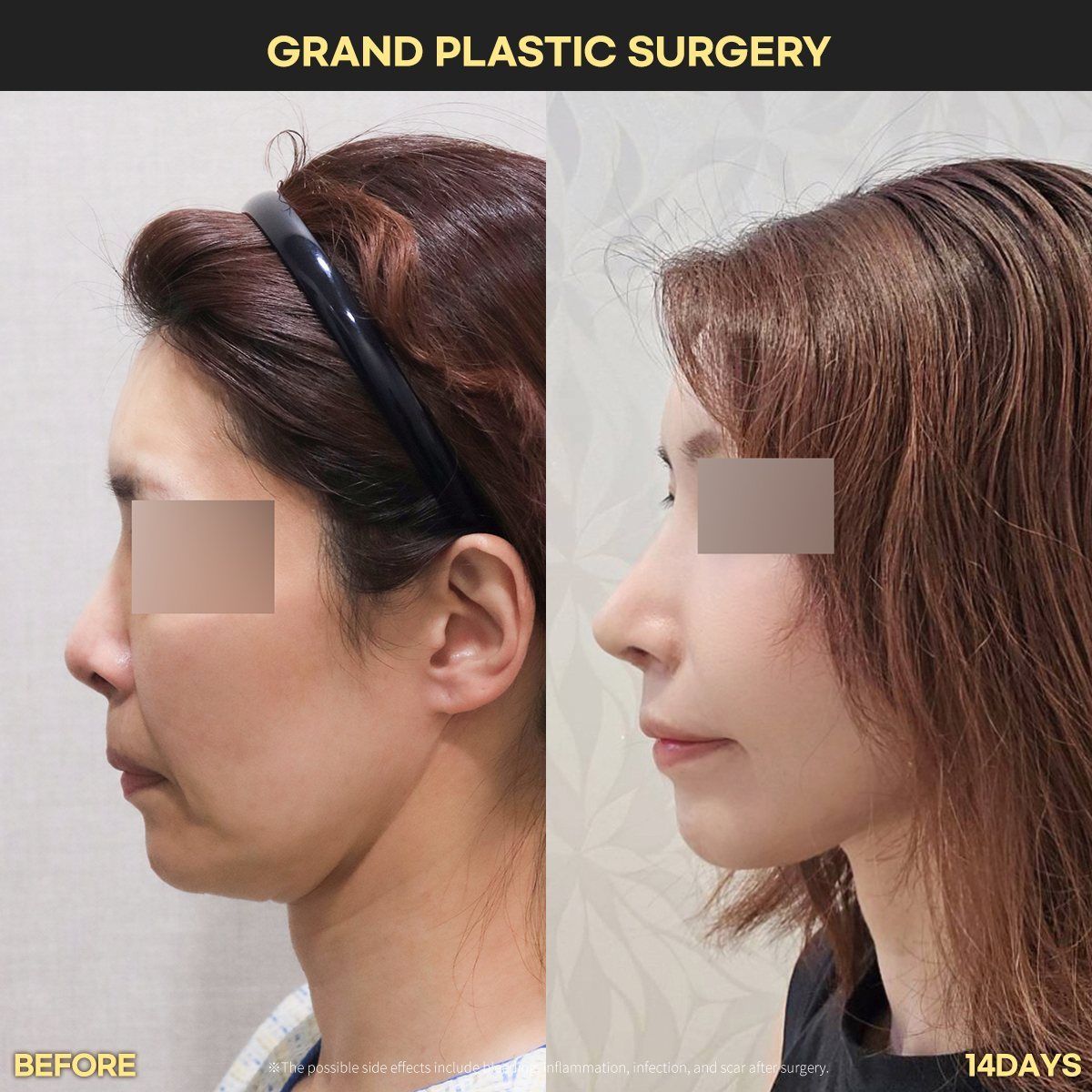 Rhinoplasty, profile: before and 14 days at Grand Plastic Surgery, Seoul