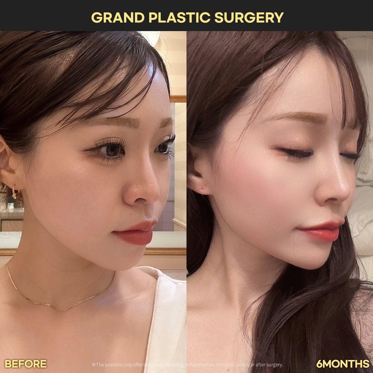 Rhinoplasty, oblique view: before and 6 months at Grand Plastic Surgery, Seoul