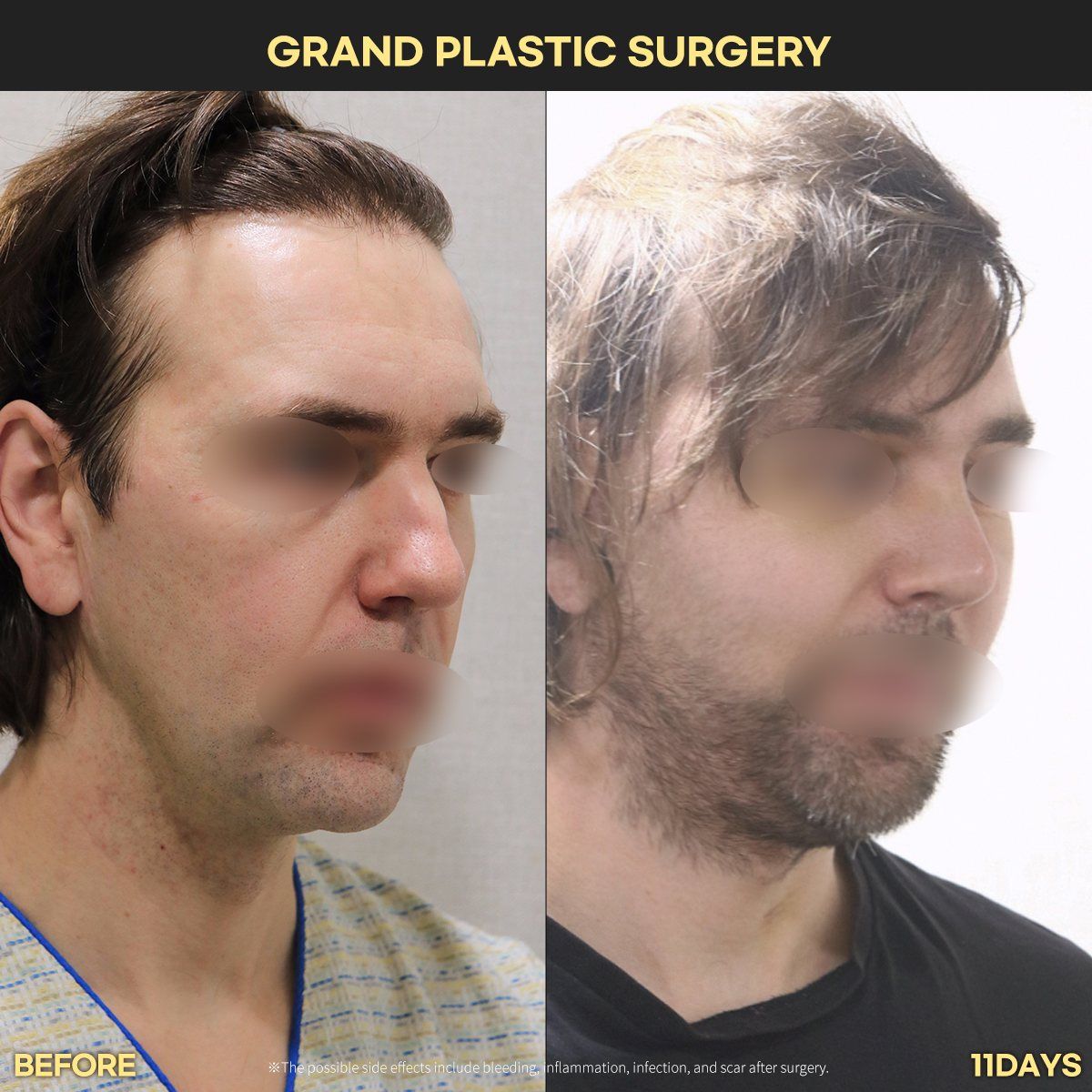 Male rhinoplasty: before and 11 days at Grand Plastic Surgery, Seoul