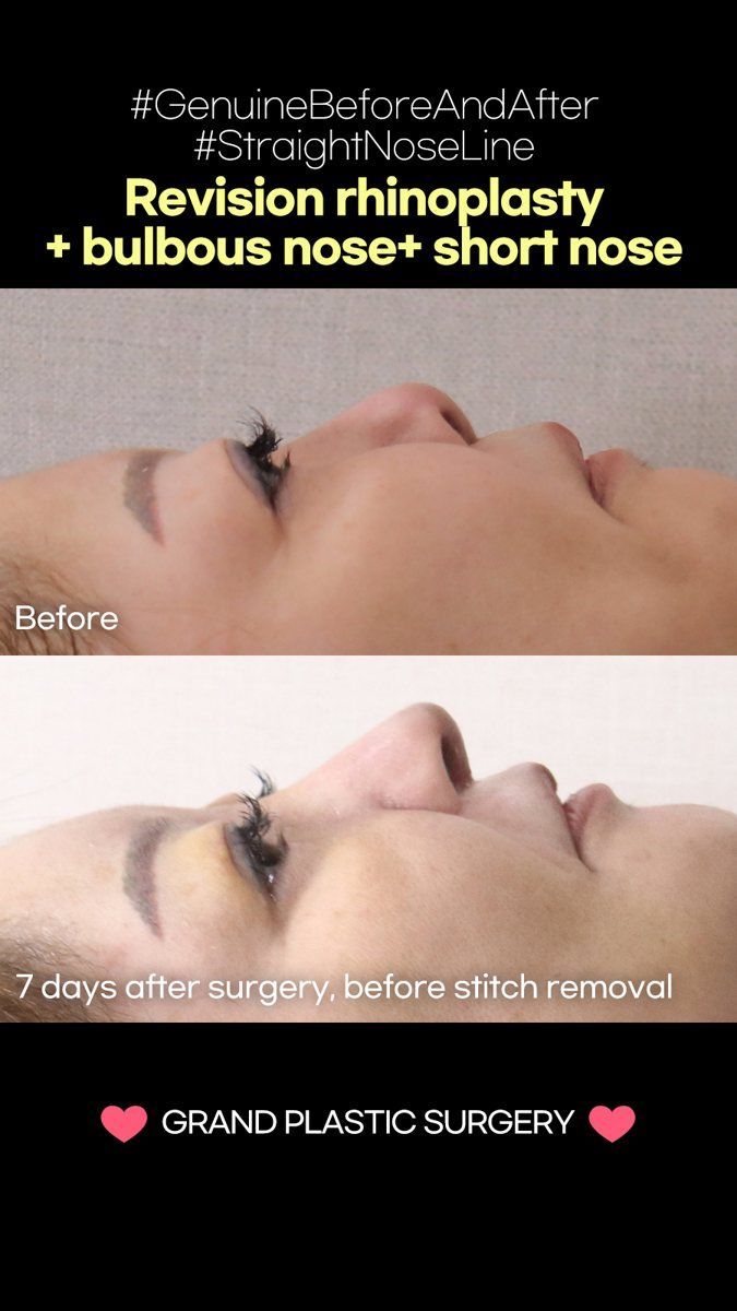 Revision rhinoplasty with bulbous tip and short nose correction: before and 7 days at Grand Plastic Surgery, Seoul