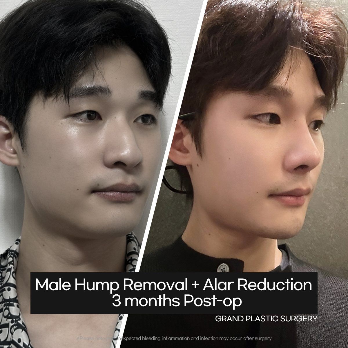 Male hump removal and alar reduction: before and 3 months at Grand Plastic Surgery, Seoul