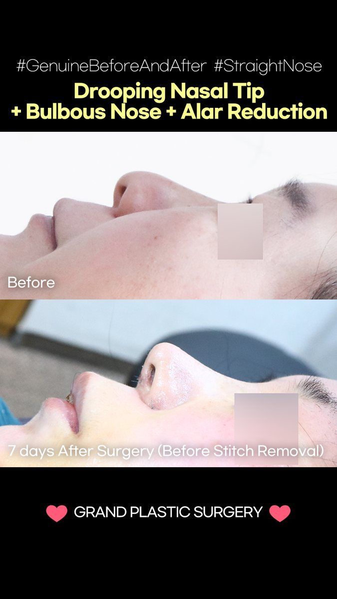 Drooping tip, bulbous tip and alar reduction: before and 7 days at Grand Plastic Surgery, Seoul