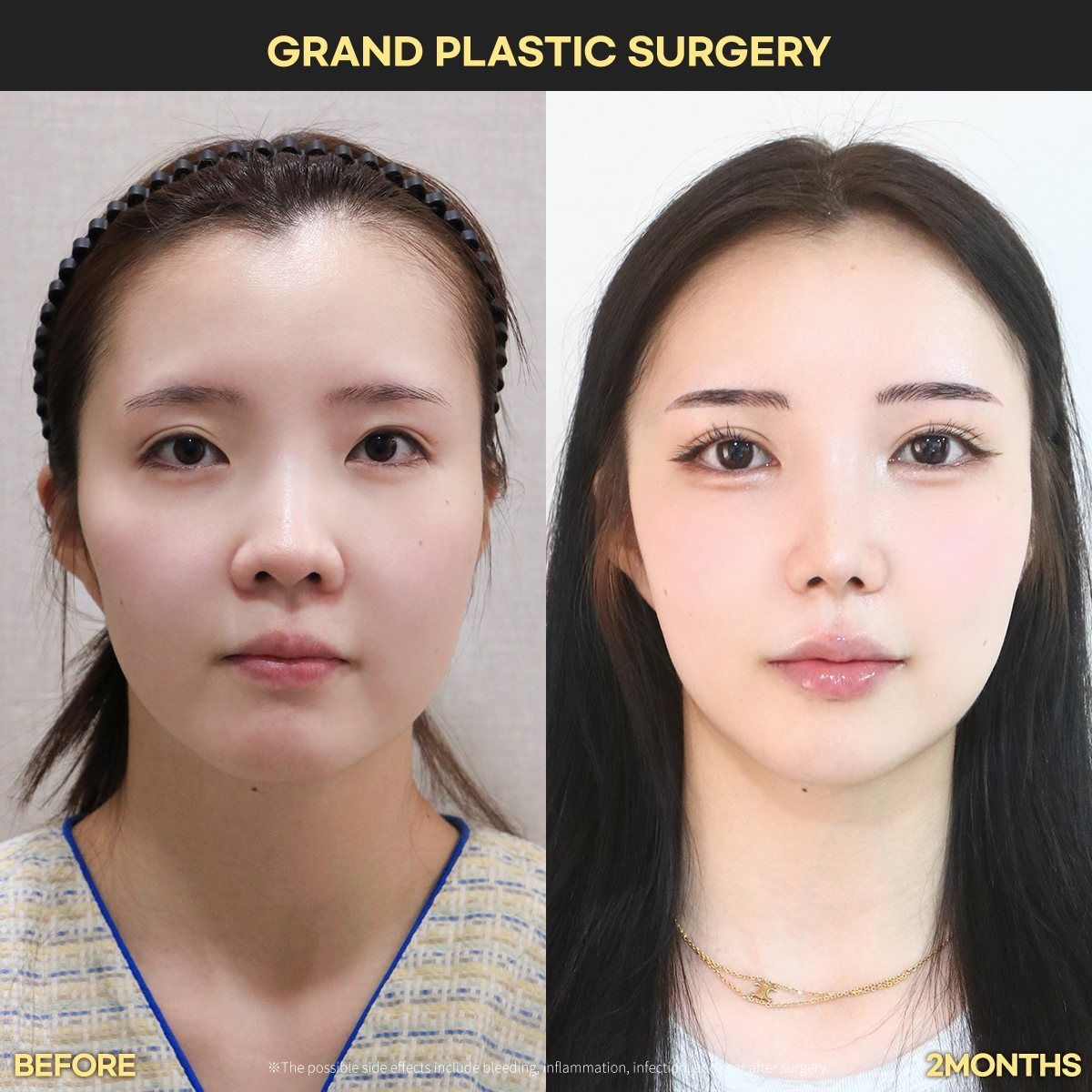 Rhinoplasty, front view: before and 2 months at Grand Plastic Surgery, Seoul