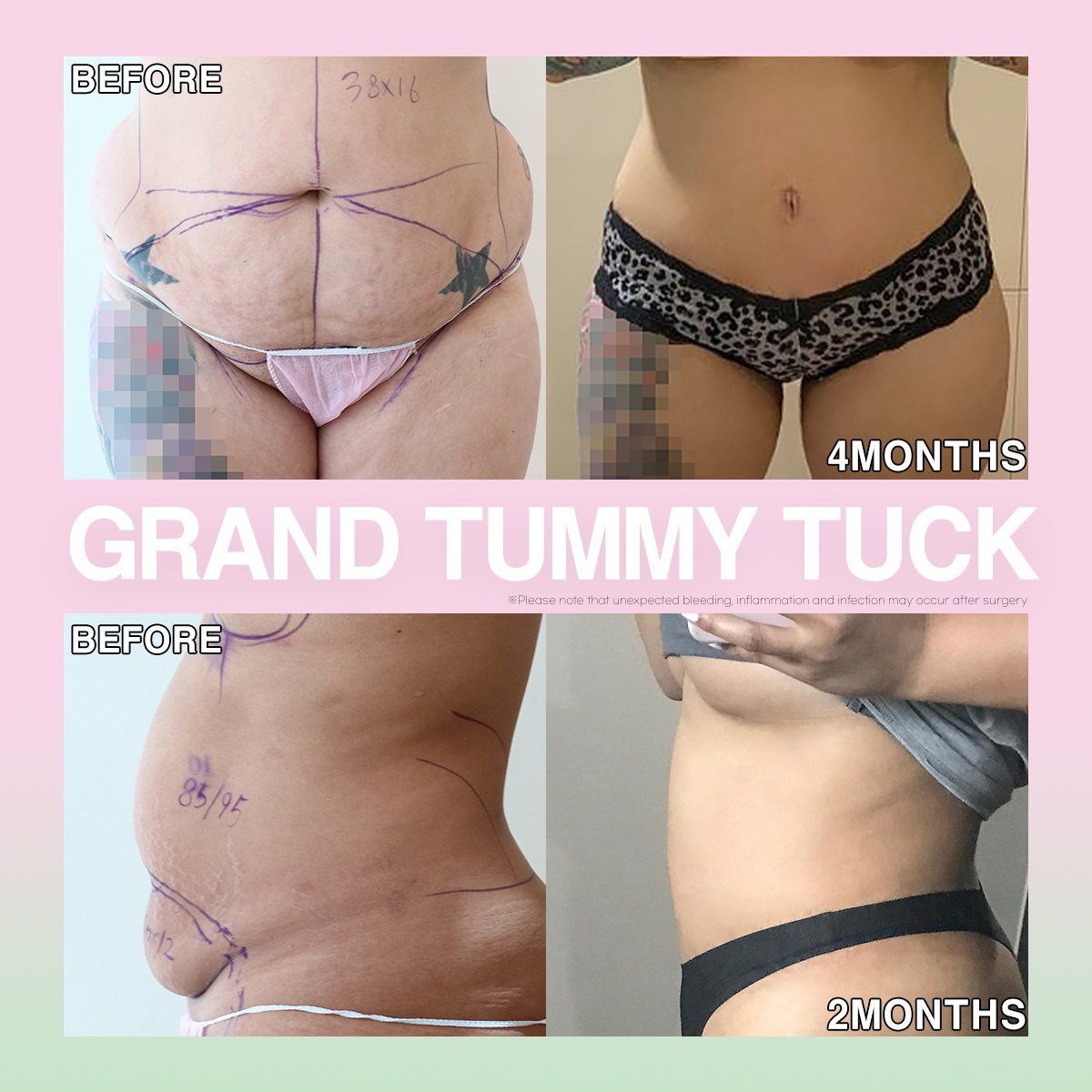 Tummy tuck: before, 2 months and 4 months at Grand Plastic Surgery, Seoul