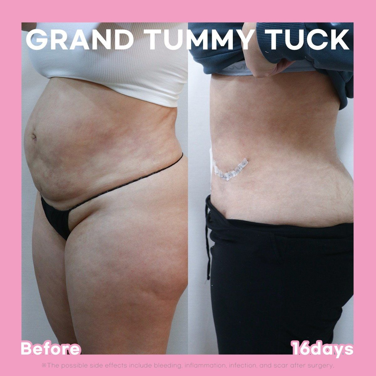 Tummy tuck: before and 16 days at Grand Plastic Surgery, Seoul