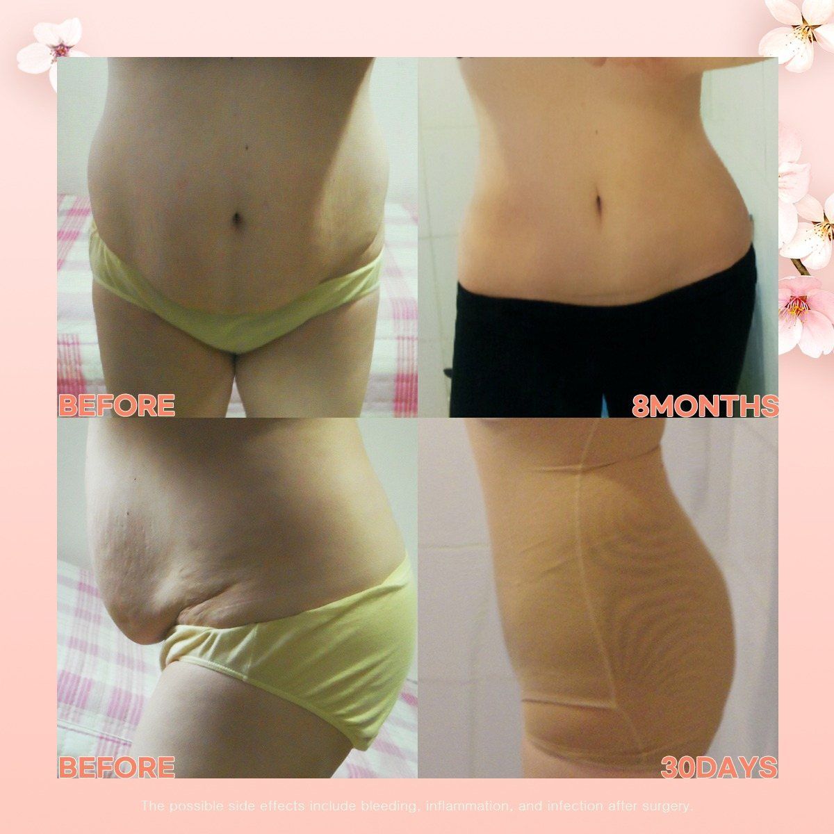 Tummy tuck: before, 30 days and 8 months at Grand Plastic Surgery, Seoul