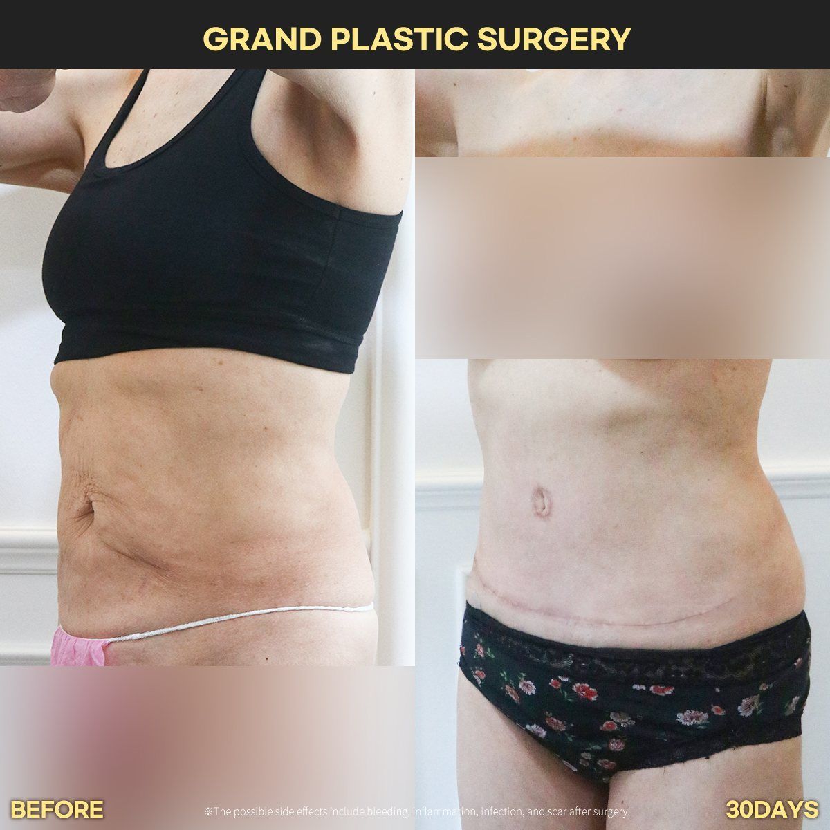 Tummy tuck: before and 30 days at Grand Plastic Surgery, Seoul