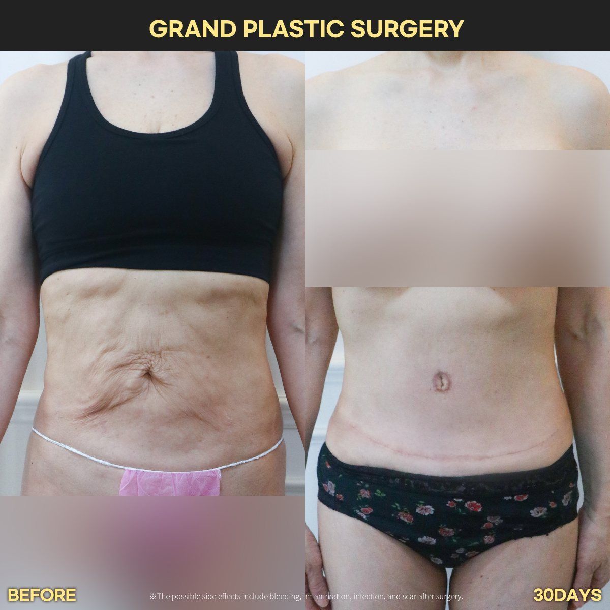 Tummy tuck, front view: before and 30 days at Grand Plastic Surgery, Seoul