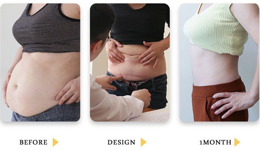 Abdominoplasty: before, surgical design and 1 month at Grand Plastic Surgery, Seoul