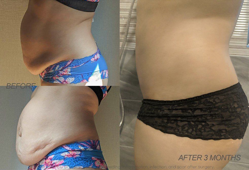 Tummy tuck, side view: before and 3 months at Grand Plastic Surgery, Seoul