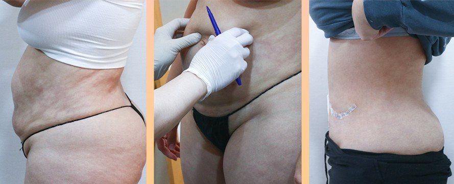 Tummy tuck: before, surgical design and after at Grand Plastic Surgery, Seoul