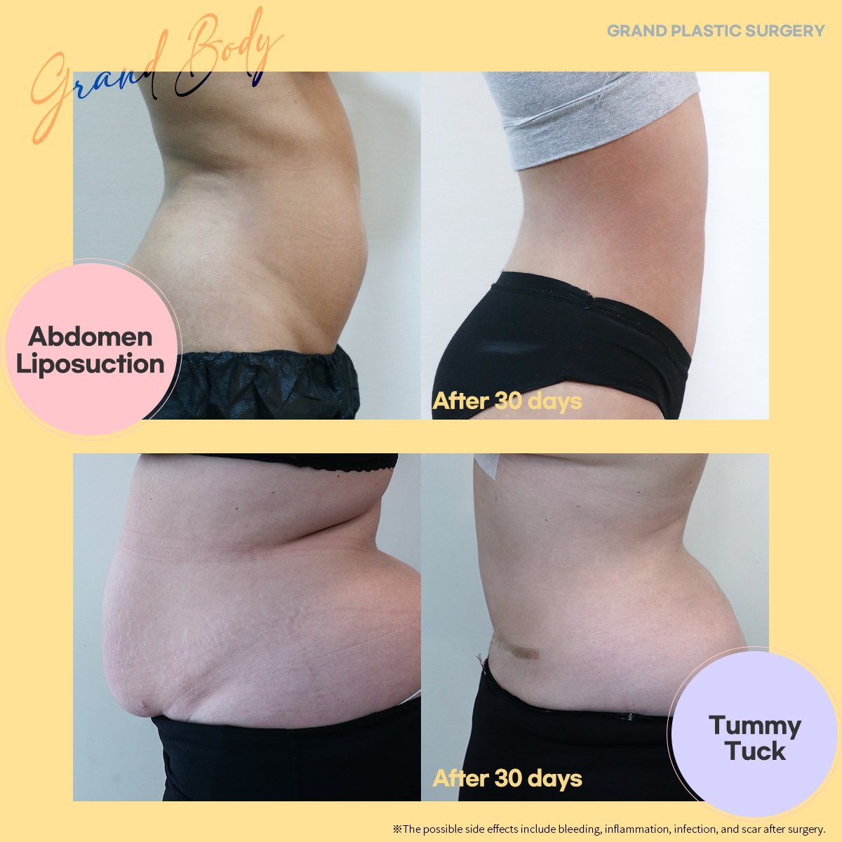 Abdomen liposuction and tummy tuck: before and 30 days at Grand Plastic Surgery, Seoul