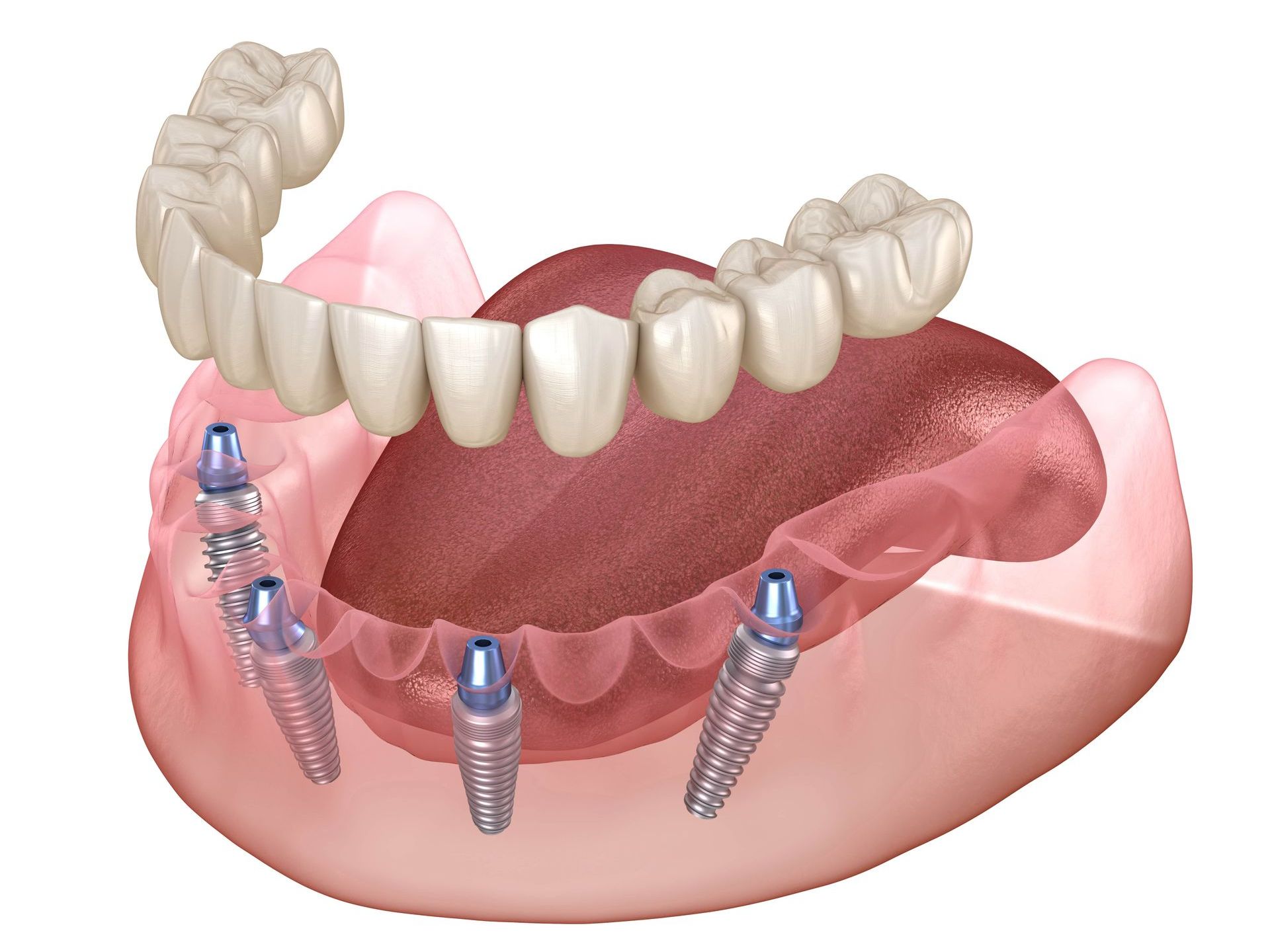 A computer generated image of a full denture with dental implants