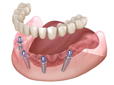 A computer generated image of a full denture with dental implants