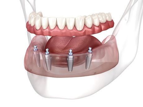 A computer generated image of a bottom jaw full arch implant