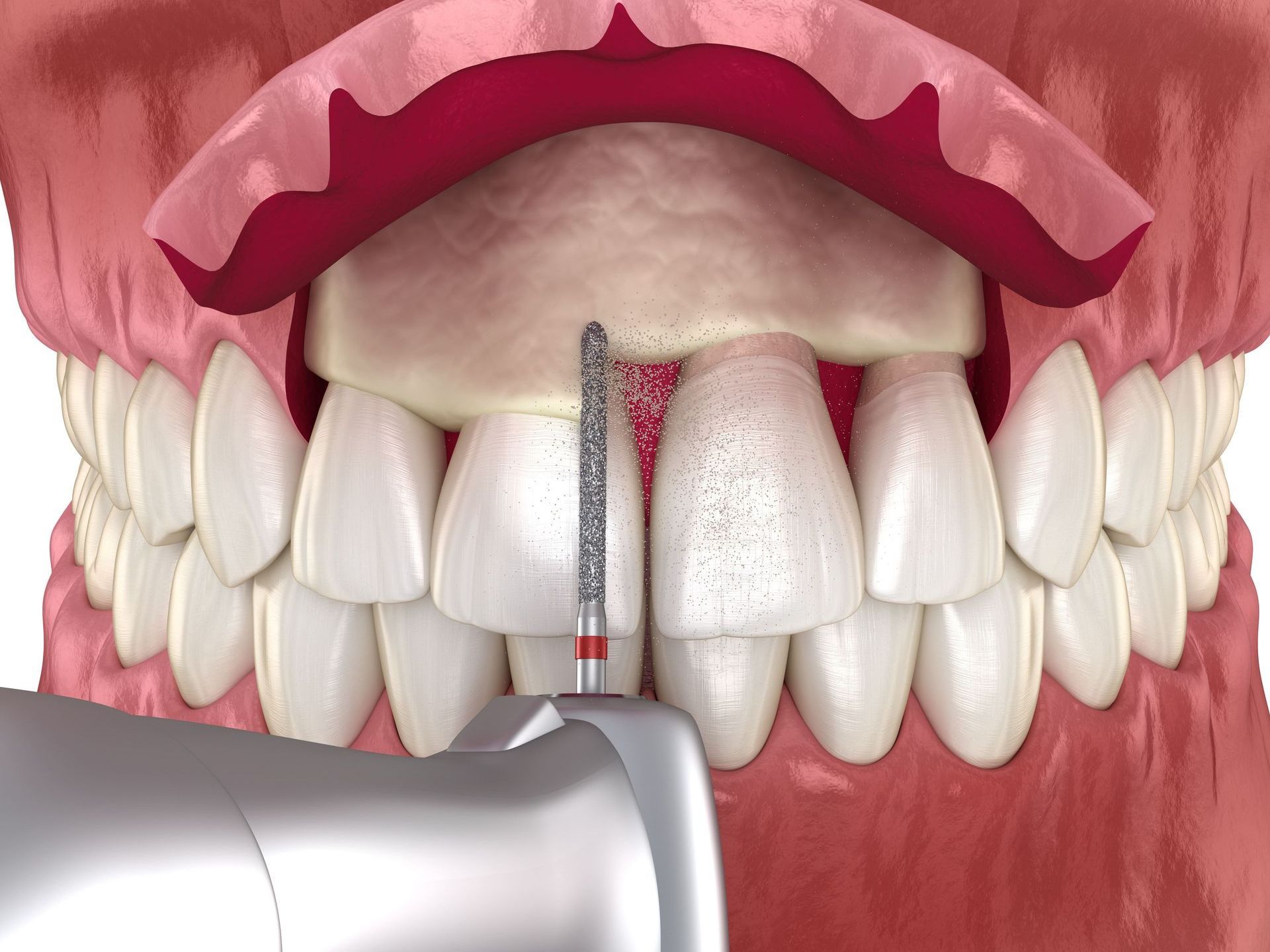 A computer generated image of a crown lengthening procedure