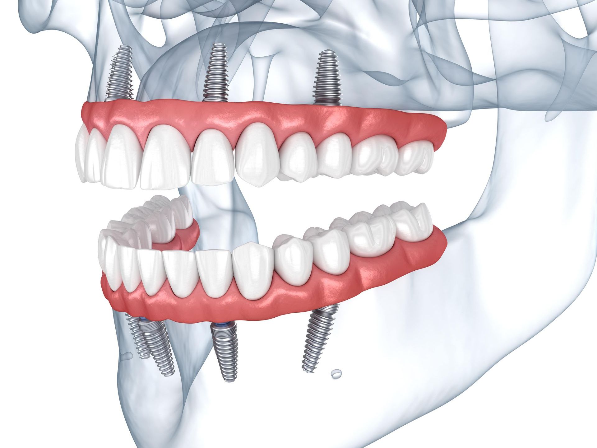 A computer generated image of full arch dental implants on the top and bottom