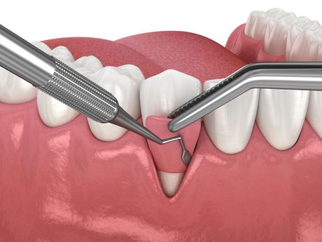 A computer generated image of a gum grafting procedure