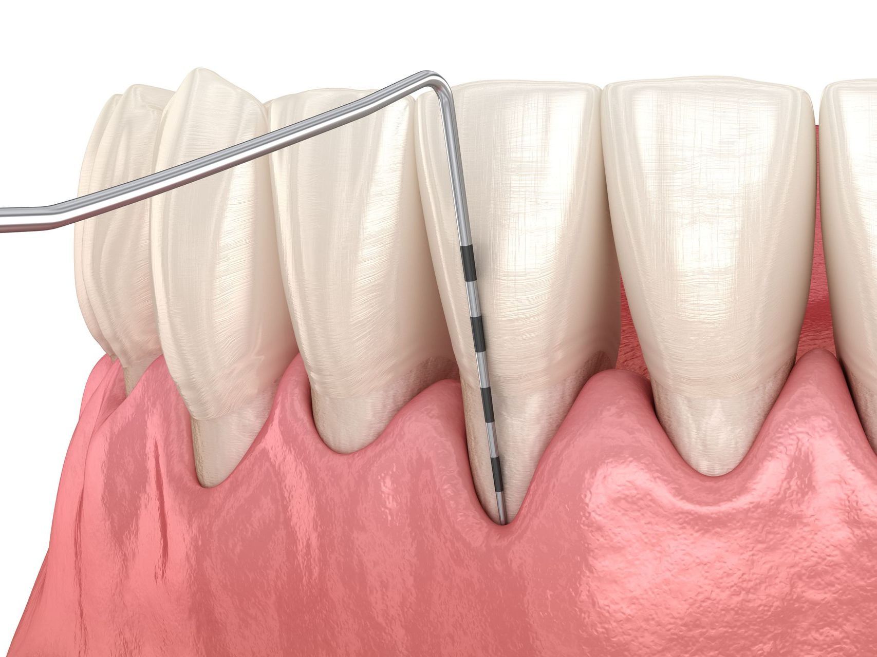 A computer generated image of a tool measuring the gum line