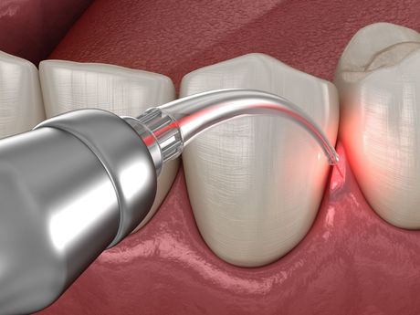 A computer generated image of laser gum surgery