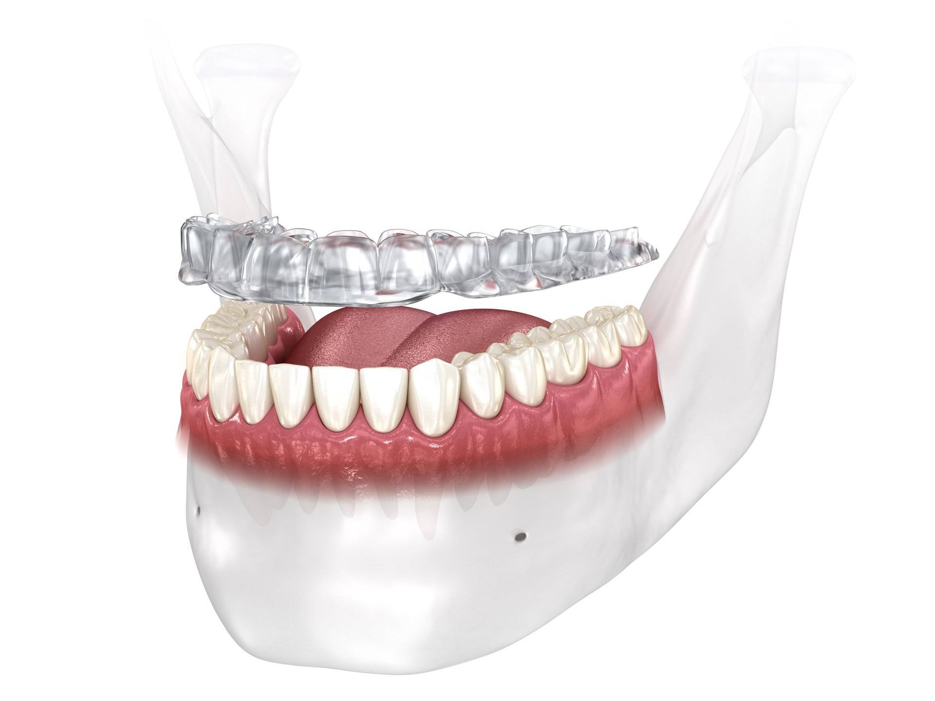 A computer generated image of an oral appliance above a bottom jaw