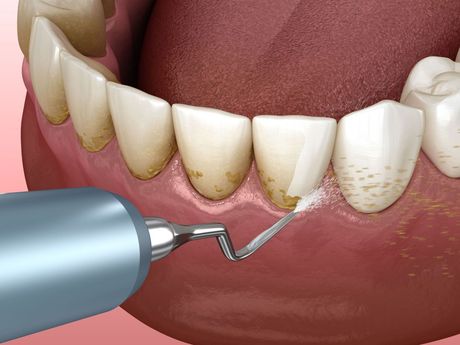 A computer generated image of teeth being cleaned with high powered water