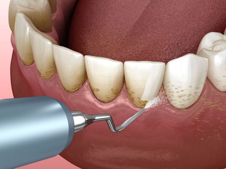 A computer generated image of teeth being cleaned with high powered water