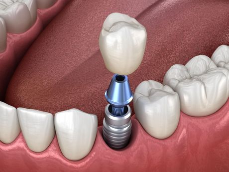 dental implants