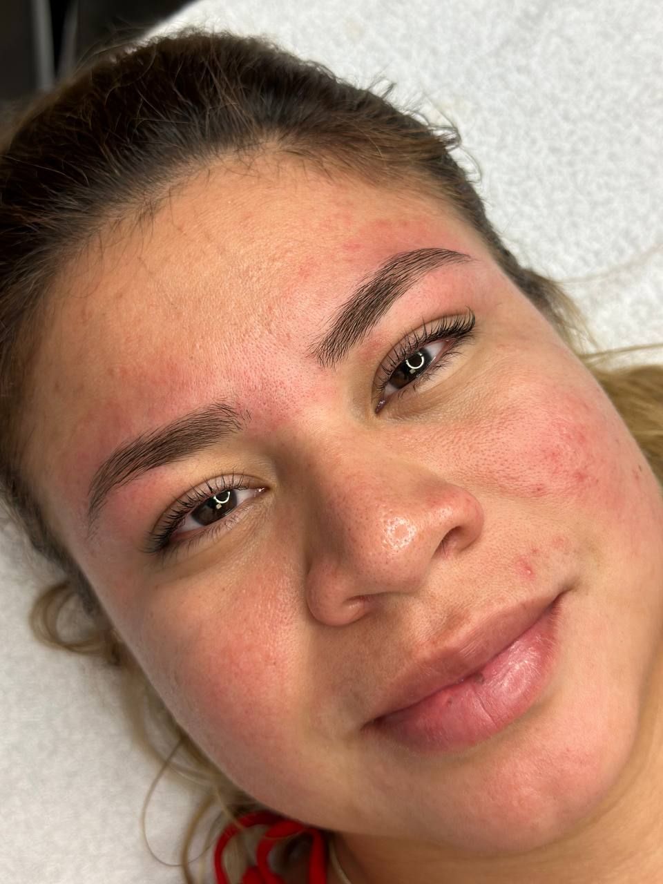 Woman with recently tattooed eyebrows and facial redness.