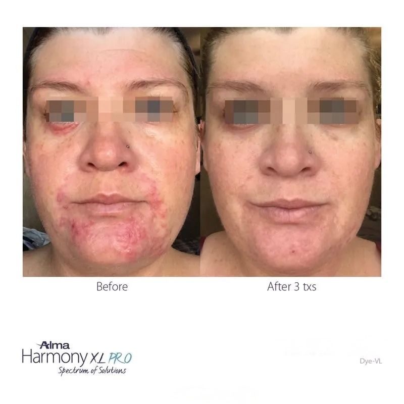 Before/after comparison: Red skin condition on face improves after 3 months of treatment.