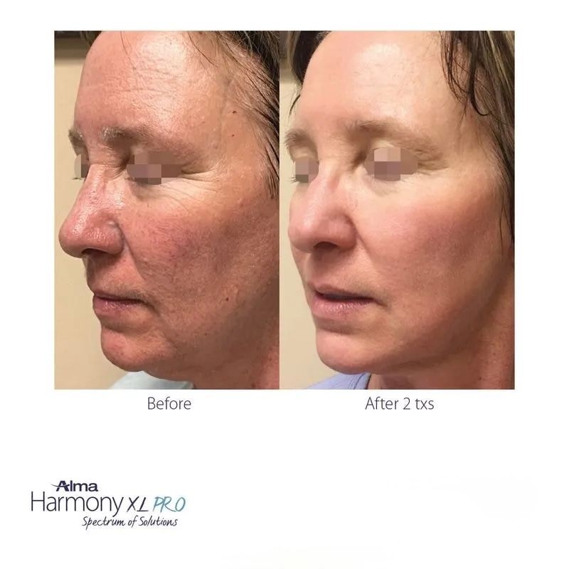 Before and after photos: face shows reduction of wrinkles and redness after Alma Harmony XL PRO treatment.