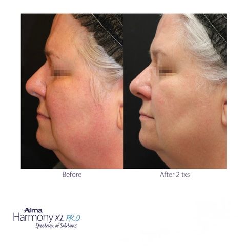 Side-by-side comparison: woman's face before and after treatment, reducing visible double chin.
