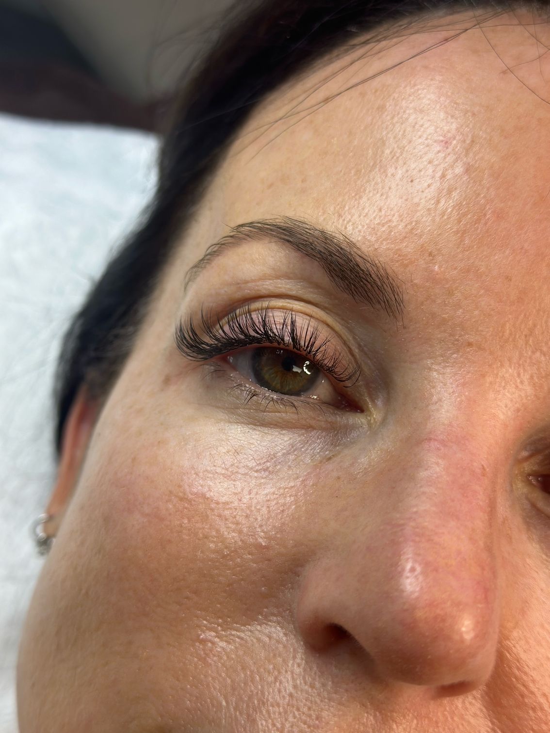 Close-up of a person's eye and eyebrow after a cosmetic procedure; skin is slightly red and shiny.