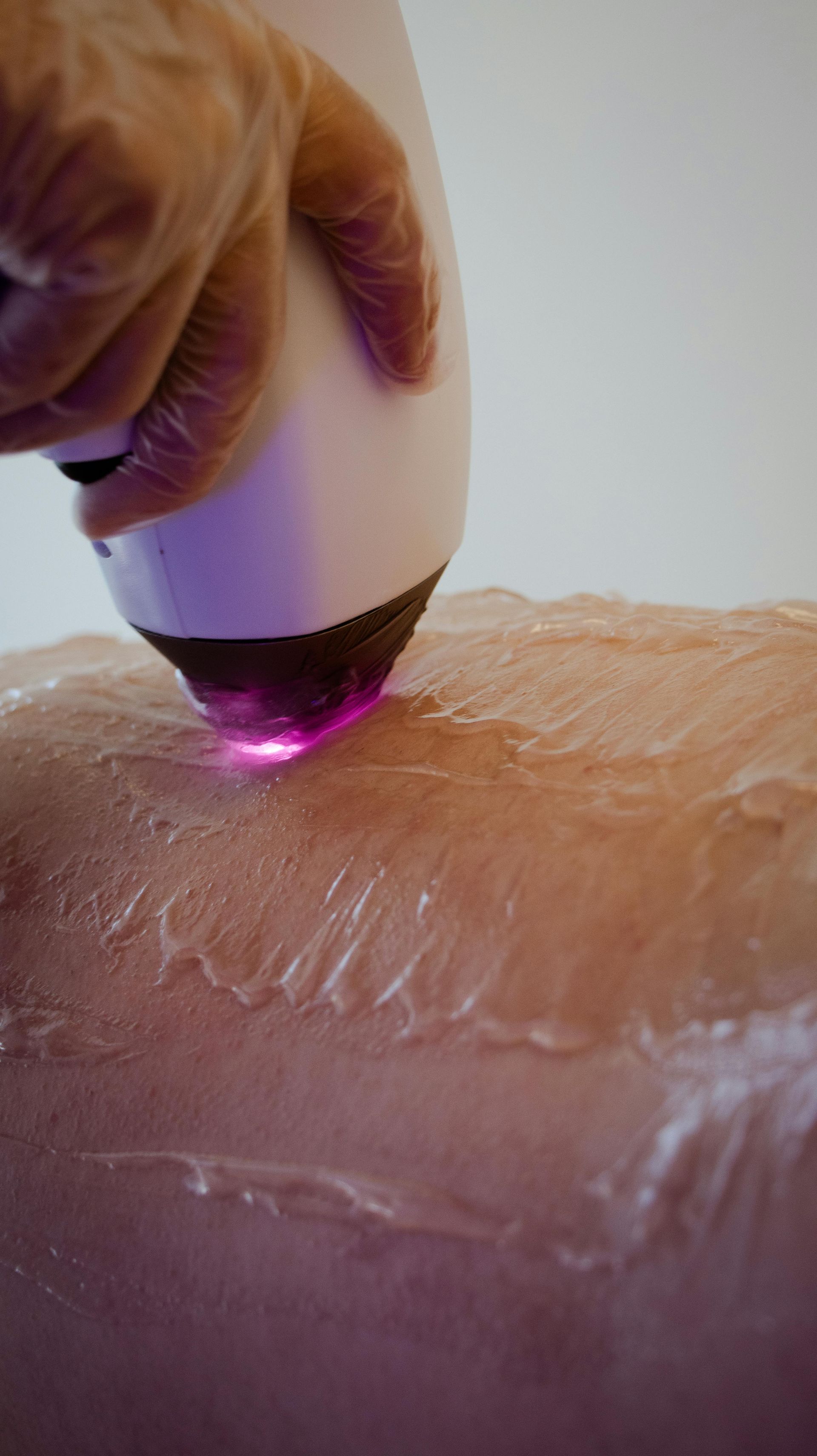 Laser hair removal on skin, hand with device, purple light.