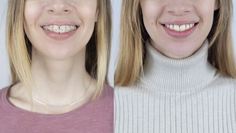 Woman's mouth and neck before and after orthodontic treatment. She smiles with braces, then without, in a turtleneck.