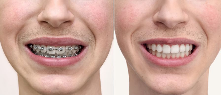Side-by-side comparison of a person's mouth with braces and after braces. They are smiling.