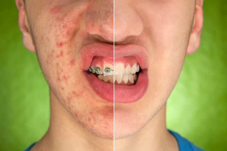A face split, showing acne on one side and clear skin, with braces, on the other.