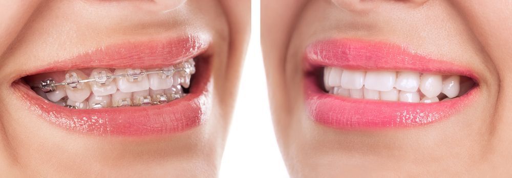 A side-by-side comparison of teeth with braces and without, showing improved smile.