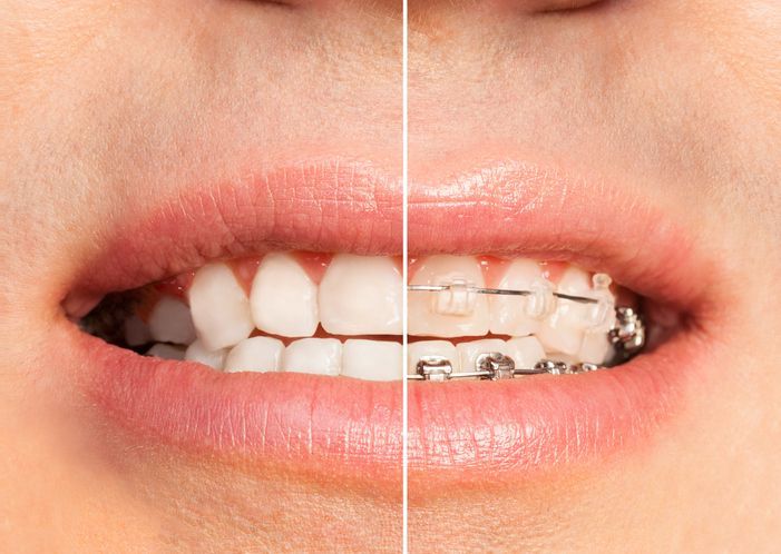 Side-by-side comparison of teeth. Left: straight white teeth. Right: teeth with clear braces.
