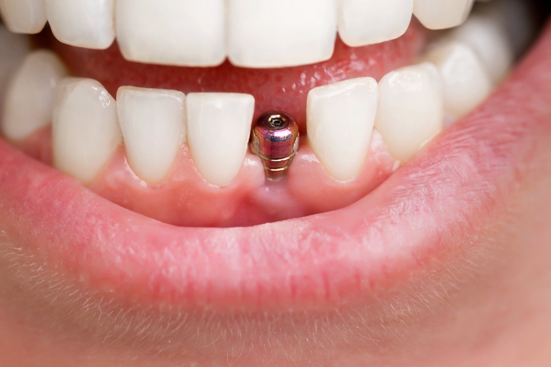 impianti dentali