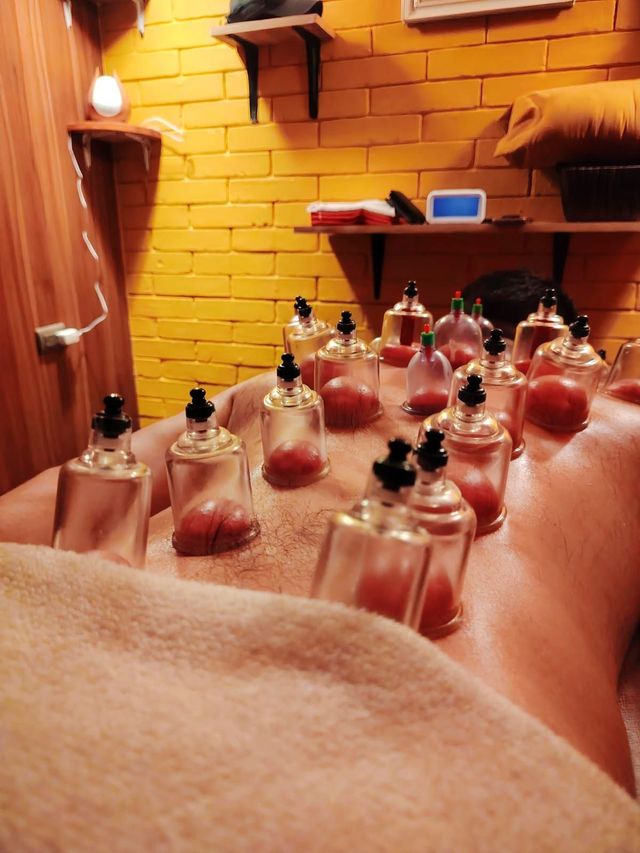Terapia con ventosas con varias ventosas de vidrio en la espalda de una persona, en una sala de tratamiento con luz cálida